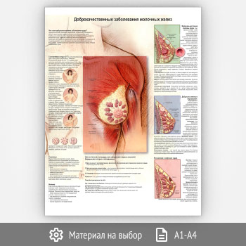 Плакат «Доброкачественные заболевания молочных желез» (ЗОЖ-08, 1 лист)