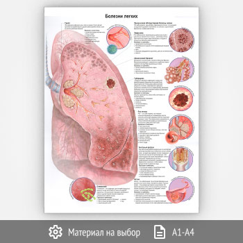 Плакат «Болезни легких» (ЗОЖ-09, 1 лист)