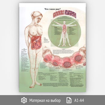 Плакат «Что такое рак?» (ЗОЖ-19, 1 лист)