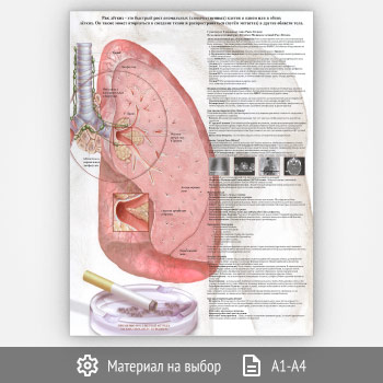 Плакат «Рак легких» (ЗОЖ-21, 1 лист)
