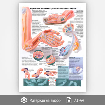 Плакат «Синдром запястного канала (кистевой туннельный синдром)» (ЗОЖ-24, 1 лист)