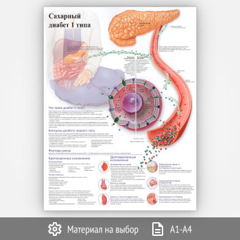 Плакат «Сахарный диабет 1 типа» (ЗОЖ-26, 1 лист)