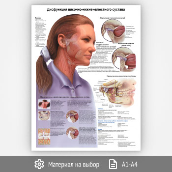 Плакат «Дисфункция височно-нижнечелюстного сустава» (ЗОЖ-33, 1 лист)