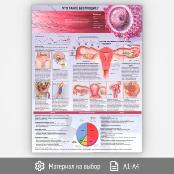 Плакат «Что такое бесплодие?» (ЗОЖ-45, 1 лист)