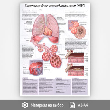 Плакат «Хроническая обструктивная болезнь легких (ХОБЛ)» (ЗОЖ-49, 1 лист)